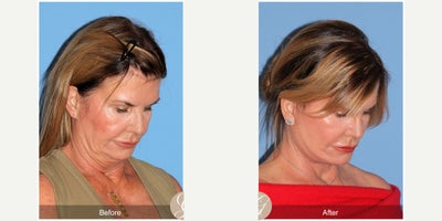 Case: 10505 - before and after photo of 66 year old woman treated with Deep Plane Facelift, Facelift, Neck Lift, MACS Facelift by Kevin Sadati, DO