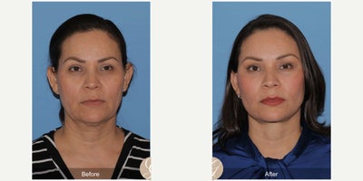 Case: 10506 - before and after photo of 51 year old woman treated with Deep Plane Facelift, Facelift, Neck Lift, Brow Lift, Facial Fat Transfer, MACS Facelift by Kevin Sadati, DO