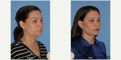 Case: 10508 - before and after photo of 51 year old woman treated with Deep Plane Facelift, Facelift, Neck Lift, Brow Lift, Facial Fat Transfer, MACS Facelift by Kevin Sadati, DO