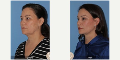 Case 10509 - 51 year old woman treated with Deep Plane Facelift, Facelift, Neck Lift, Brow Lift, Facial Fat Transfer, MACS Facelift