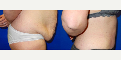 Case 1051 - Woman treated with Tummy Tuck