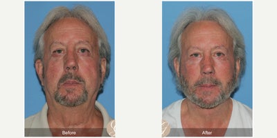 Case 10510 - 71 year old man treated with Deep Plane Facelift, Facelift, Neck Lift, Brow Lift, Facial Fat Transfer, MACS Facelift