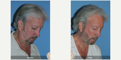 Case 10512 - 71 year old man treated with Deep Plane Facelift, Facelift, Neck Lift, Brow Lift, Facial Fat Transfer, MACS Facelift