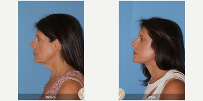 Case 10513 - 63 year old woman treated with Deep Plane Facelift, Facelift, Neck Lift, Brow Lift, Eyelid Surgery, Facial Fat Transfer, MACS Fa