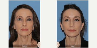 Case 10514 - 56 year old woman treated with Deep Plane Facelift, Facelift, Neck Lift, Eyelid Surgery, Facial Fat Transfer, MACS Facelift