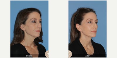 Case 10515 - 56 year old woman treated with Deep Plane Facelift, Facelift, Neck Lift, Eyelid Surgery, Facial Fat Transfer, MACS Facelift