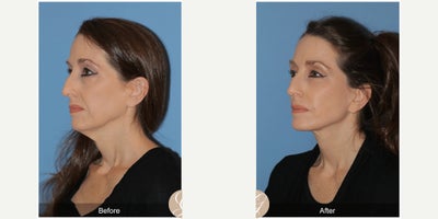 Case 10516 - 56 year old woman treated with Deep Plane Facelift, Facelift, Neck Lift, Eyelid Surgery, Facial Fat Transfer, MACS Facelift