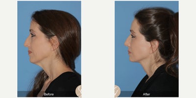 Case 10517 - 56 year old woman treated with Deep Plane Facelift, Facelift, Neck Lift, Eyelid Surgery, Facial Fat Transfer, MACS Facelift