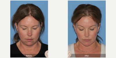 Case 10519 - 51 year old woman treated with Deep Plane Facelift, Facelift, Neck Lift, Brow Lift, Botox, MACS Facelift