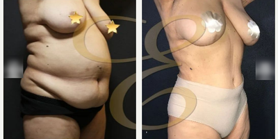 Case 1052 - Woman treated with Tummy Tuck