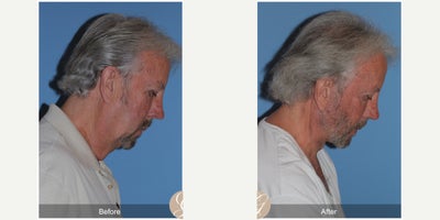 Case 10522 - 71 year old man treated with Deep Plane Facelift, Facelift, Neck Lift, Brow Lift, Facial Fat Transfer, MACS Facelift