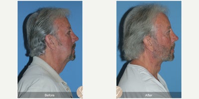 Case 10523 - 71 year old man treated with Deep Plane Facelift, Facelift, Neck Lift, Brow Lift, Facial Fat Transfer, MACS Facelift