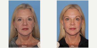 Case 10524 - 63 year old woman treated with Deep Plane Facelift, Facelift, Neck Lift, Brow Lift, Eyelid Surgery, CO2 Laser, MACS Facelift