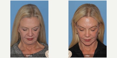 Case 10525 - 63 year old woman treated with Deep Plane Facelift, Facelift, Neck Lift, Brow Lift, Eyelid Surgery, CO2 Laser, MACS Facelift
