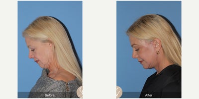 Case 10527 - 63 year old woman treated with Deep Plane Facelift, Facelift, Neck Lift, Brow Lift, Eyelid Surgery, CO2 Laser, MACS Facelift