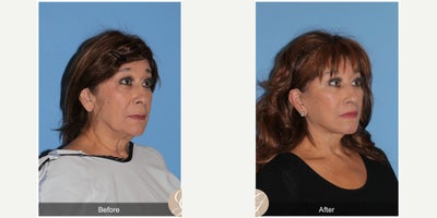 Case 10528 - 70 year old woman treated with Deep Plane Facelift, Facelift, Neck Lift, Eyelid Surgery, Lip Lift, MACS Facelift