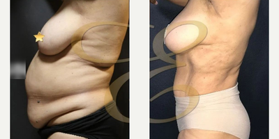 Case 1053 - Woman treated with Tummy Tuck