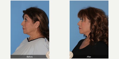 Case 10530 - 70 year old woman treated with Deep Plane Facelift, Facelift, Neck Lift, Eyelid Surgery, Lip Lift, MACS Facelift