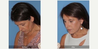 Case 10531 - 63 year old woman treated with Deep Plane Facelift, Facelift, Neck Lift, Brow Lift, Eyelid Surgery, Facial Fat Transfer, MACS Fa