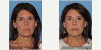 Case 10532 - 63 year old woman treated with Deep Plane Facelift, Facelift, Neck Lift, Brow Lift, Eyelid Surgery, Facial Fat Transfer, MACS Fa