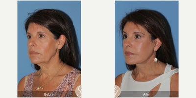 Case 10533 - 63 year old woman treated with Deep Plane Facelift, Facelift, Neck Lift, Brow Lift, Eyelid Surgery, Facial Fat Transfer, MACS Fa