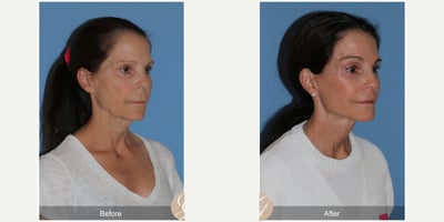 Case 10536 - 57 year old woman treated with Deep Plane Facelift, Facelift, Neck Lift, Brow Lift, Facial Fat Transfer, Lip Lift, CO2 Laser, Bo