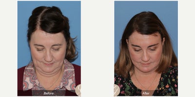 Case 10538 - 63 year old woman treated with Deep Plane Facelift, Facelift, Neck Lift, Brow Lift, MACS Facelift