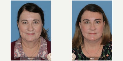 Case 10539 - 63 year old woman treated with Deep Plane Facelift, Facelift, Neck Lift, Brow Lift, MACS Facelift