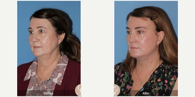 Case 10540 - 63 year old woman treated with Deep Plane Facelift, Facelift, Neck Lift, Brow Lift, MACS Facelift