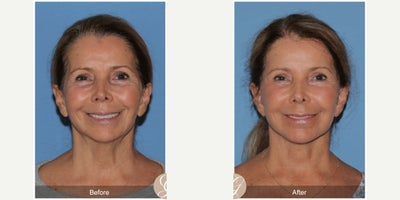 Case 10541 - 69 year old woman treated with Deep Plane Facelift, Facelift, Neck Lift, Dermal Fillers, MACS Facelift