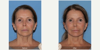 Case 10542 - 69 year old woman treated with Deep Plane Facelift, Facelift, Neck Lift, Dermal Fillers, MACS Facelift
