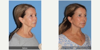 Case 10543 - 69 year old woman treated with Deep Plane Facelift, Facelift, Neck Lift, Dermal Fillers, MACS Facelift