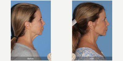 Case 10544 - 69 year old woman treated with Deep Plane Facelift, Facelift, Neck Lift, Dermal Fillers, MACS Facelift