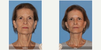 Case 10545 - 66 year old woman treated with Deep Plane Facelift, Facelift, Neck Lift, Brow Lift, Eyelid Surgery, Facial Fat Transfer, MACS Fa