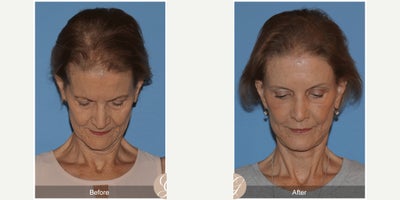 Case 10546 - 66 year old woman treated with Deep Plane Facelift, Facelift, Neck Lift, Brow Lift, Eyelid Surgery, Facial Fat Transfer, MACS Fa