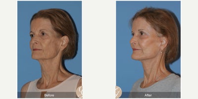 Case 10548 - 66 year old woman treated with Deep Plane Facelift, Facelift, Neck Lift, Brow Lift, Eyelid Surgery, Facial Fat Transfer, MACS Fa