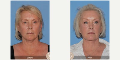 Case 10549 - 60 year old woman treated with Deep Plane Facelift, Facelift, Neck Lift, Brow Lift, Facial Fat Transfer, MACS Facelift