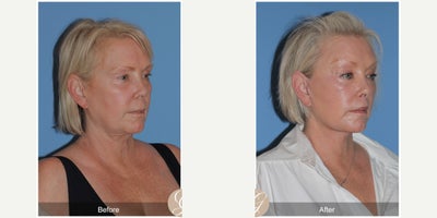 Case 10550 - 60 year old woman treated with Deep Plane Facelift, Facelift, Neck Lift, Brow Lift, Facial Fat Transfer, MACS Facelift