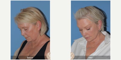 Case 10551 - 60 year old woman treated with Deep Plane Facelift, Facelift, Neck Lift, Brow Lift, Facial Fat Transfer, MACS Facelift