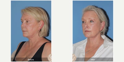 Case 10552 - 60 year old woman treated with Deep Plane Facelift, Facelift, Neck Lift, Brow Lift, Facial Fat Transfer, MACS Facelift