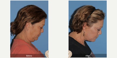 Case 10553 - 58 year old woman treated with Deep Plane Facelift, Facelift, Neck Lift, Lip Lift, Eyelid Surgery, MACS Facelift
