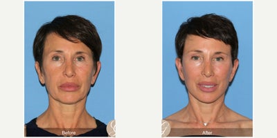 Case 10554 - 60 year old woman treated with Deep Plane Facelift, Facelift, Neck Lift, Facial Fat Transfer, MACS Facelift