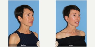 Case 10555 - 60 year old woman treated with Deep Plane Facelift, Facelift, Neck Lift, Facial Fat Transfer, MACS Facelift