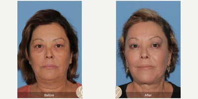 Case 10556 - 58 year old woman treated with Deep Plane Facelift, Facelift, Neck Lift, Lip Lift, Eyelid Surgery, MACS Facelift
