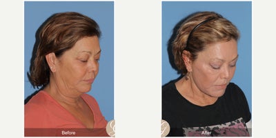 Case 10557 - 58 year old woman treated with Deep Plane Facelift, Facelift, Neck Lift, Lip Lift, Eyelid Surgery, MACS Facelift