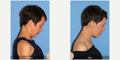 Case 10559 - 60 year old woman treated with Deep Plane Facelift, Facelift, Neck Lift, Facial Fat Transfer, MACS Facelift