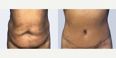 Case 106 - Woman treated with Tummy Tuck