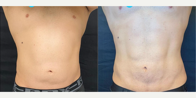 Case: 10621 - before and after photo of Man treated with A.T.L.A.S. Procedure and Renuvion Skin Tightening by Nathaniel Villanueva, MD
