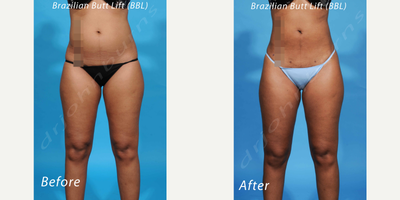 Case: 10622 - before and after photo of 35-44 year old woman treated with Liposculpture by John L. Burns Jr., MD