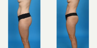 Case: 10623 - before and after photo of 35-44 year old woman treated with Abdominal Etching, Diastasis Recti Repair, Drainless Tummy Tuck, Liposculpture, Liposuction, M by John L. Burns Jr., MD